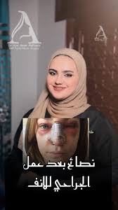 لتخفيف الوذمة بعد تجميل الأنف ⬇️, إليك خمس نقاط هامة 🌸, ولتكوني آية من  الجمال ..♥️, احجزي موعدك مع الدكتورة آية ✨: , 📍Damascus & 📍AlQamishli,  📞What’s Up : +963 996048612
