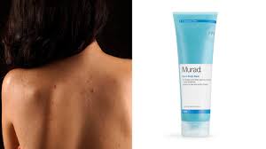 How To Get Rid Of Acne On Your Back And Chest Asap Chest Acne Treatment Body Acne Acne Treatment