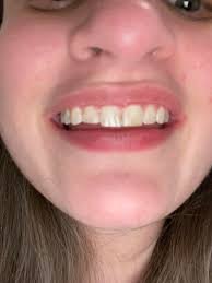 Hi, just a quick message about composite bonding. I had it done yesterday 