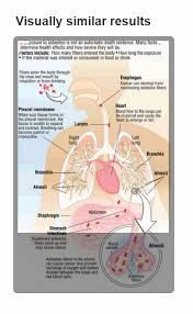 Chronic lymphocytic leukemia (cll) is a type of cancer of the bone marrow and blood. Mesothelioma Cancer Coughing Up Blood Apklas