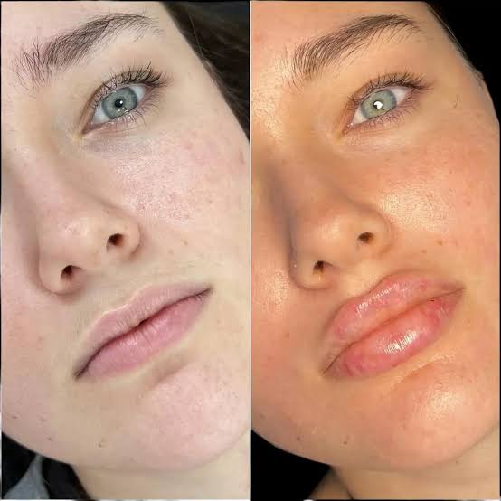 Dermal Fillers Dubai | Face, Lip, Nose & Jawline Filler Offers Reviews -  Best Aesthetic Clinic