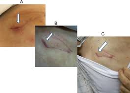 Some patients with fast and chaotic heart rhythms or who have survived sudden cardiac arrest need an implantable cardioverter defibrillator (icd). Conservative Therapy For The Management Of Cardiac Implantable Electronic Device Infection Sciencedirect