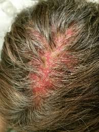 3 symptoms of a sunburnt scalp. Hair Loss Can Be Stopped