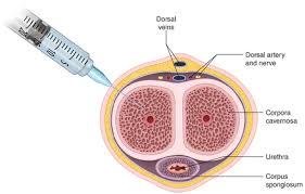 Image result for Priapism