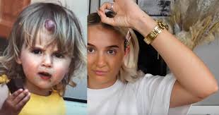 Molly-Mae Hague shares photos of strawberry birthmark for first time