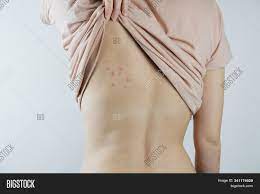 Feb 07, 2013 · the only thing you'll need to change here is the outline that defines the waist. Damaged Skin On Female Image Photo Free Trial Bigstock