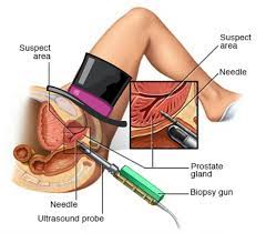 A biopsy can also help explain why a transplanted kidney is not working properly. What Is A Biopsy