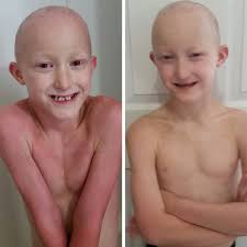 Image result for Anhidrosis