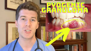 Image result for granuloma gum disease