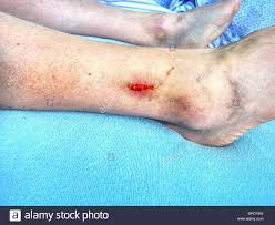 Frische Blutige Stelle In Der Haut Hasslichen Blauen Fleck Am Bein Detaillierte Erschossen Die Offene Wunde Vor Dem Gips In Ambulancy Stockfotografie Alamy