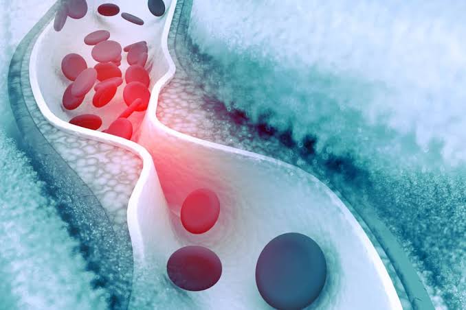 Atherosclerosis: Ano ang kondisyong ito, at paano ito magagamot?