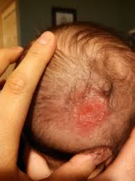 Image result for sores on the head in children