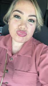 Laser Eraser Clark Nj