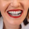 Dental braces (also known as braces, orthodontic cases, or cases) are devices used in orthodontics that align and straighten teeth and help position them with regard to a person's bite, while also aiming to improve dental health. Https Encrypted Tbn0 Gstatic Com Images Q Tbn And9gcsbpegejdl81rni7v8wkq Rmaahepyowveooccfn4aj5gz 2isp Usqp Cau