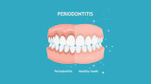 How To Prevent Gingivitis From Your Home - Aurora Dental Group
