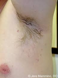 Regardless of gender, tags can stick out on anyone&#x27;s skin, although they. Skin Tags American Osteopathic College Of Dermatology Aocd