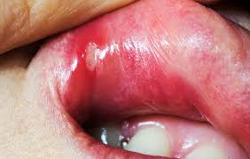 In the early stages, mouth cancer rarely causes any pain. Home Remedies For Canker Sores Men S Health