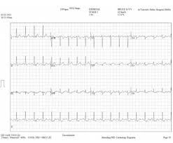 racgp cardiac stress testing stress electrocardiography