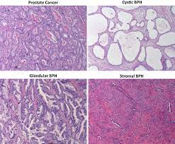 Many people do not experience early symptoms of prostate cancer. Representative Images Of H E Stained Histology Same Magnification Download Scientific Diagram