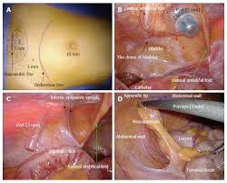 But how do you know if your stomach pain is appendicitis or if it's actually progressed into a ruptured appendix? How Much Does An Appendix Surgery Cost In Nigeria Public Health