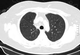 Los dos casos de mucormicosis pulmonar notificados por fürbringer en 1876 fueron los primeros descritos. Https Www Medigraphic Com Pdfs Facmed Un 2016 Un162e Pdf