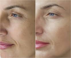 Fibroblast Plasma Skin Tightening