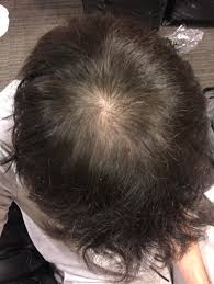 The other reason for hair loss in younger women is usually attributed to hormonal fluctuations, the trichological effects of which however could just be temporary. I Am 20 And I Am Kinda Scared Of The Sexual Effects Of Finasteride Also Every Male Person In My Family Has Man Pattern Baldness I Dont Have A Lot Of Hair