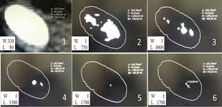 Correlation Between Hounsfield Unit Value And Stone Composition In Nephrolithiasis