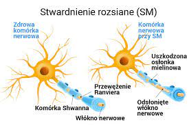 Pierwotna przyczyna choroby nie została ustalona. Leczenie Stwardnienia Rozsianego Polem Magnetycznym