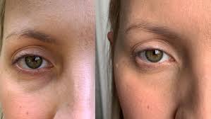Biossance Squalane Peptide Eye Gel Before And After Biossance Eye Gel Before After Biossance Peptide Eye Gel Beauty Product Health Rejuvenate Hydrate Moisturize Dark Circles Crepine Undereye Circles Eye Gel Skin
