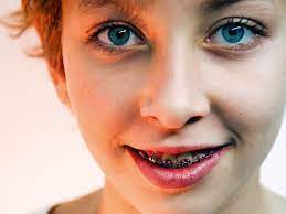 Einen ersten kontrolltermin in unserer kieferorthopädischen praxis empfehlen wir mit etwa 6 jahren. In Aller Munde Wireltern Ch