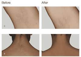 Pay as low as $29.99 and get unlimited laser hair removal for the next 24 months. Laser Hair Removal Scottsdale Az Lightsheer Desire Blume Skin Treatment