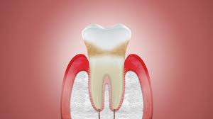 Can Receding Gums Grow Back Corsodyl