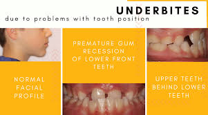 Maybe you would like to learn more about one of these? Correcting Underbites In Kids Hometown Orthodontics