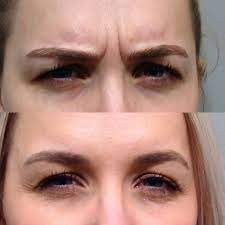 This is quite common and well within standard operating experience. Botox For Frown Lines