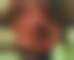Figure 1 From Benign Vulvar Vestibular Papillomatosis: An Underreported  Condition In Indian Dermatological Literature | Semantic Scholar