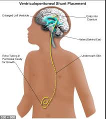 Ventriculoperitoneal Vp Shunt Market Size Share