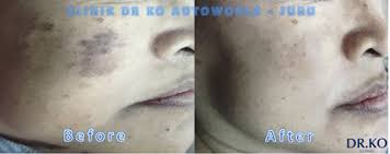 No 21 lorong mentiga 1 taman mentiga jaya pekan 26620 pahang. Pigmentation Melasma Treatment Leading Skin And Aesthetic Clinic In Malaysia