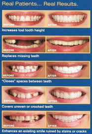 It is designed to look like a natural set of teeth. Snap On Smile Coral Gables Miami
