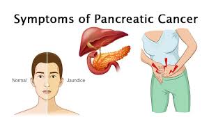 Less than 2% are alive after ten years. 8 Symptoms Of Pancreatic Cancer Womenworking