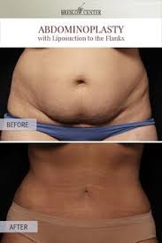 The most advanced technology, smartlipo triplex. 8 Stomach Ideas Liposuction Lipo Before And After Cosmetic Surgery