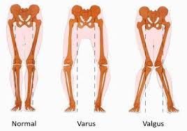 Varus Vs Valgus Knees Bow Legged Yoga Postures Physical Therapy Assistant