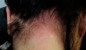 My daughter use splat hair dye to color her hair blue but had a lot of leftover dye on her scalp and ears this product says it is safe to use on skin and rea. Homoeopathic Remedies For Hair Dye Allergies