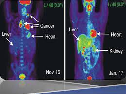 Pet scans create images which show where cells are particularly active in the body. Pet Scan Max Superspecialty Ortho Clinic