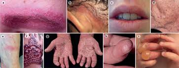 Rumor has it that tribulus is also known as puncture vine because its sharp spines can flatten bicycle tires. Contact Dermatitis Nature Reviews Disease Primers