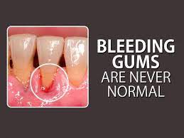 If Your Gums Bleed When You Brush It Could Be A Sign Of Gingivitis The Early Stage Of Gum Disease Bleeding Gum Gum Disease Treatment Gingivitis Remedies