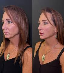 4 Syringe facial balancing from my training last week with the contour  queen! We did midcheek, chin, jawline, and lips. I'm obsessed with these  results and so is my client 😍
