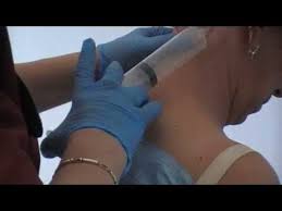 Medicamentele sunt administrate in spatiul epidural, acesta fiind zona dintre invelisul protector (dura mater). Spondiloza Cervicala Youtube