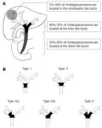 Surgical strategy for bile duct cancer: Advances and current limitations