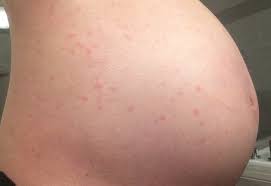 Maybe you would like to learn more about one of these? De Ce Apar Pete RoÈ™ii Pe Corp Din Cauza ApariÈ›iei Petelor Pe Stomac Pete RoÈ™ii Cu Bule Au ApÄƒrut Pe Stomac